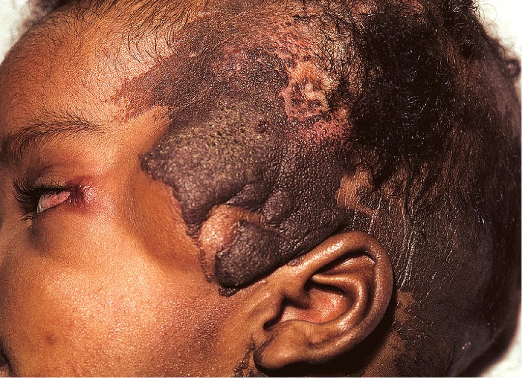 Fig. 9.38, Epidermal nevus syndrome. This infant had numerous widespread epidermal nevi in conjunction with multiple congenital anomalies.