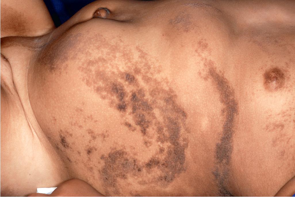 Fig. 9.39, Epidermal nevus syndrome. Multiple, whorled verrucous plaques are present in this child with multiple musculoskeletal, central nervous system, and ophthalmologic defects as well as profound developmental delay.