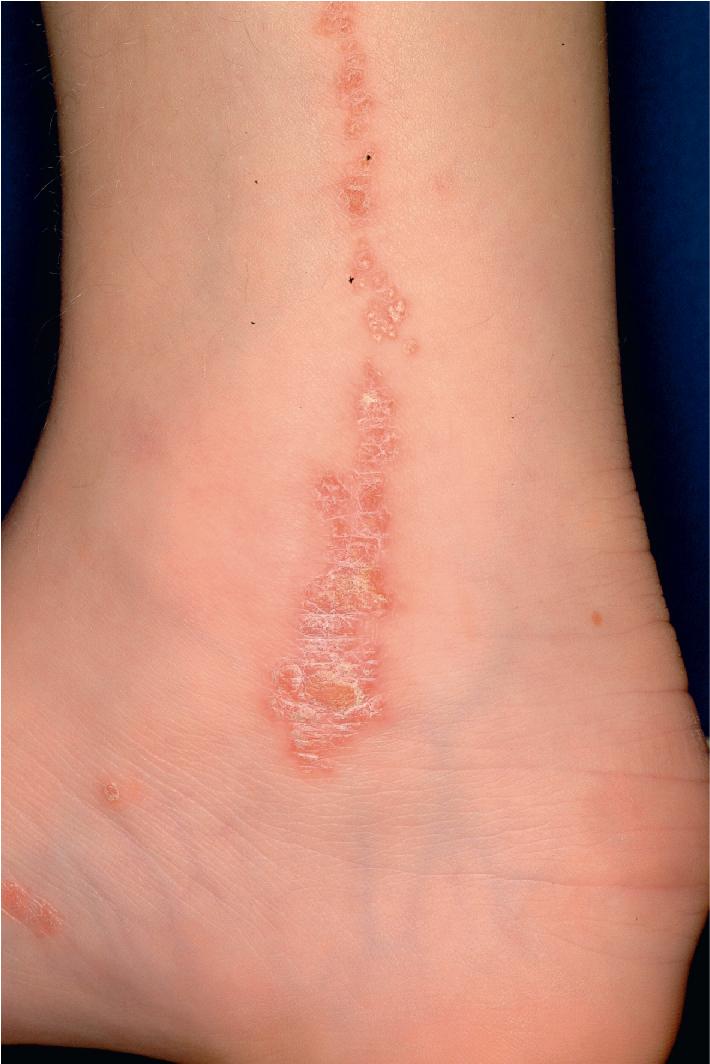 Fig. 9.40, Inflammatory linear verrucous epidermal nevus. Multiple red, scaly papules coalescing into a linear plaque on the medial leg, malleolus, and foot of a 7-year-old girl.