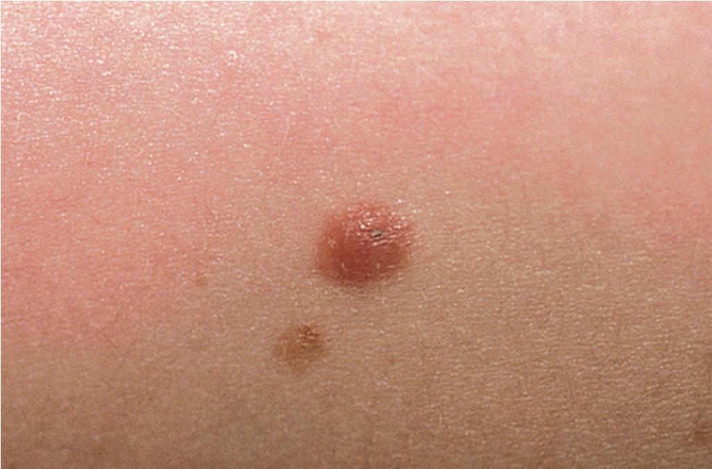 Fig. 9.4, Intradermal melanocytic nevus. A tan, fleshy papule with adjacent intradermal nevus.