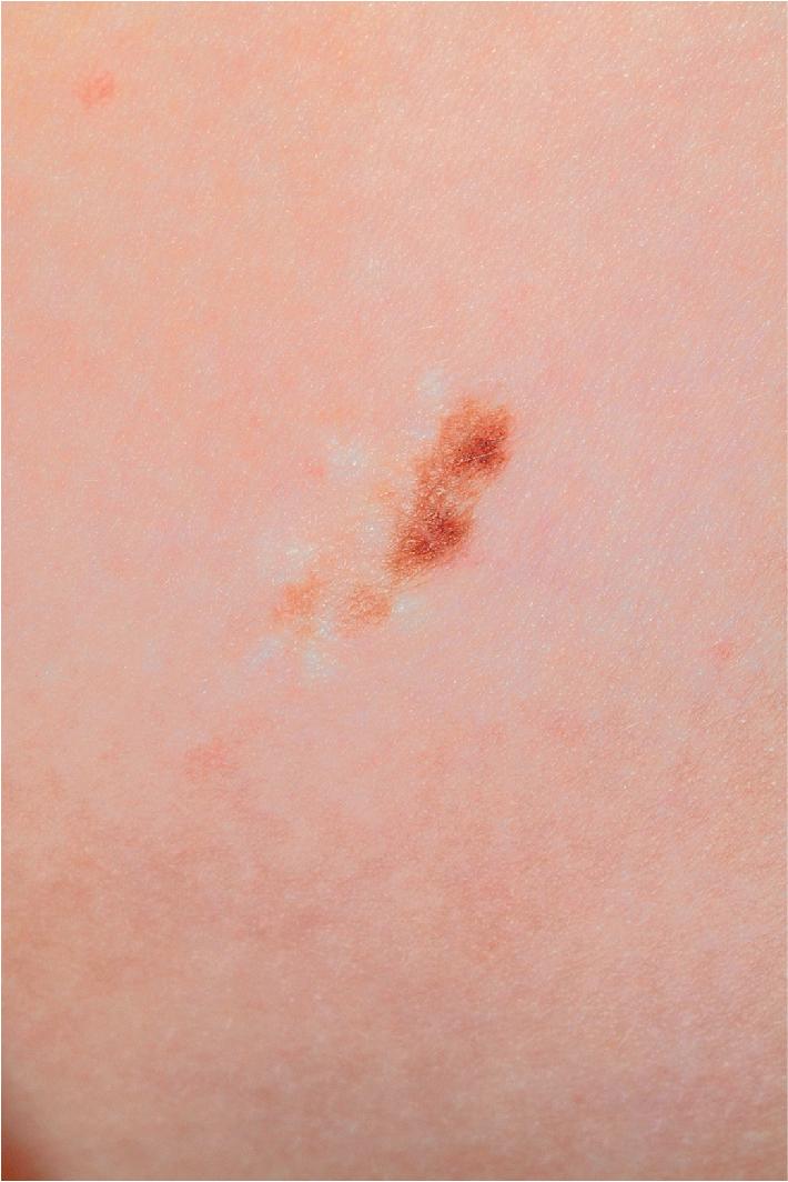 Fig. 9.5, Recurrent melanocytic nevus (within a surgical scar). The initial nevus had been incompletely excised.
