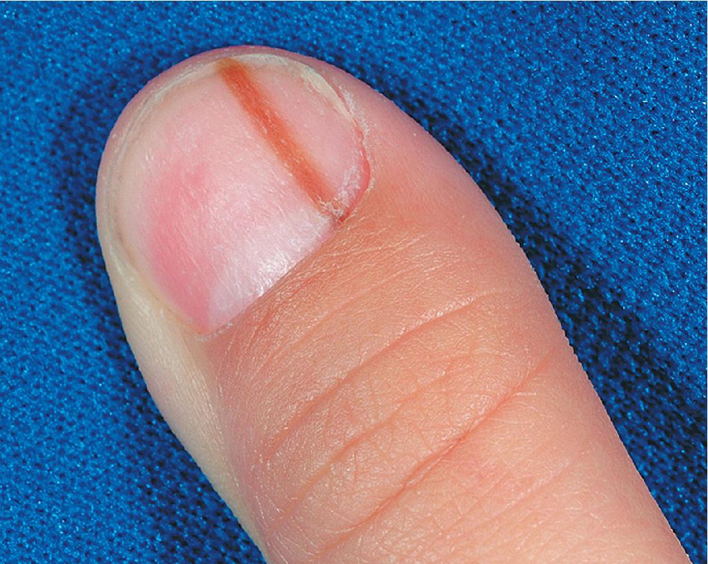 Fig. 9.7, Melanonychia striata. A 2-mm, evenly pigmented band. Note the absence of pigmentation of the proximal nailfold (negative Hutchinson sign).