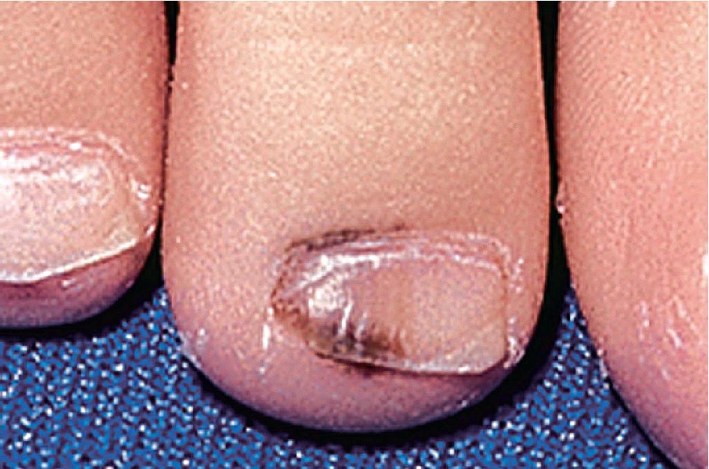 Fig. 9.8, Melanonychia striata with Hutchinson sign. Note pigmentation involving both the proximal nailfold and the distal nailfold regions. This patient underwent nail matrix biopsy; the lesion was a compound nevus without atypia.