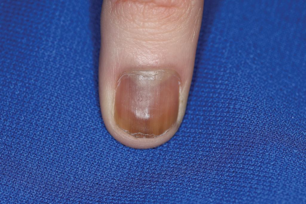 Fig. 9.9, Melanonychia striata. This teenaged girl had changes that began at 3 years of age, with gradual broadening of the band and eventual involvement of the entire nail unit. Nail matrix biopsy revealed junctional nevus with benign features.