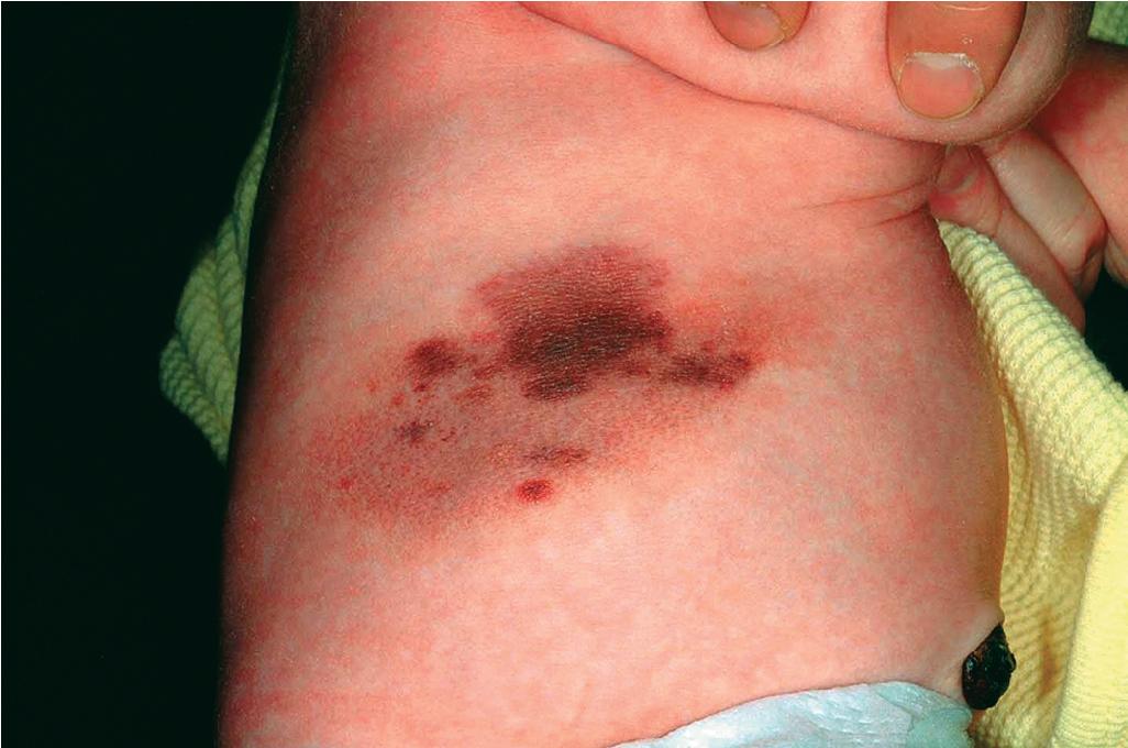 Fig. 9.10, Early congenital melanocytic nevus. Note the various shades of brown and red in this 2-week-old infant boy.