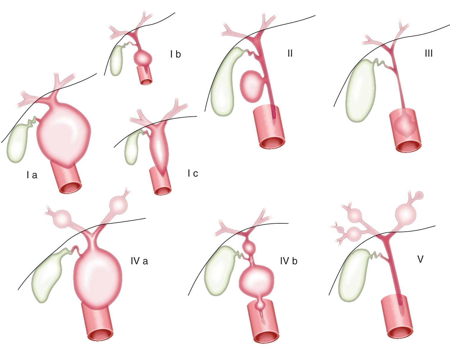 Fig. 392.1, Classification of choledochal cysts according to Todani and colleagues.