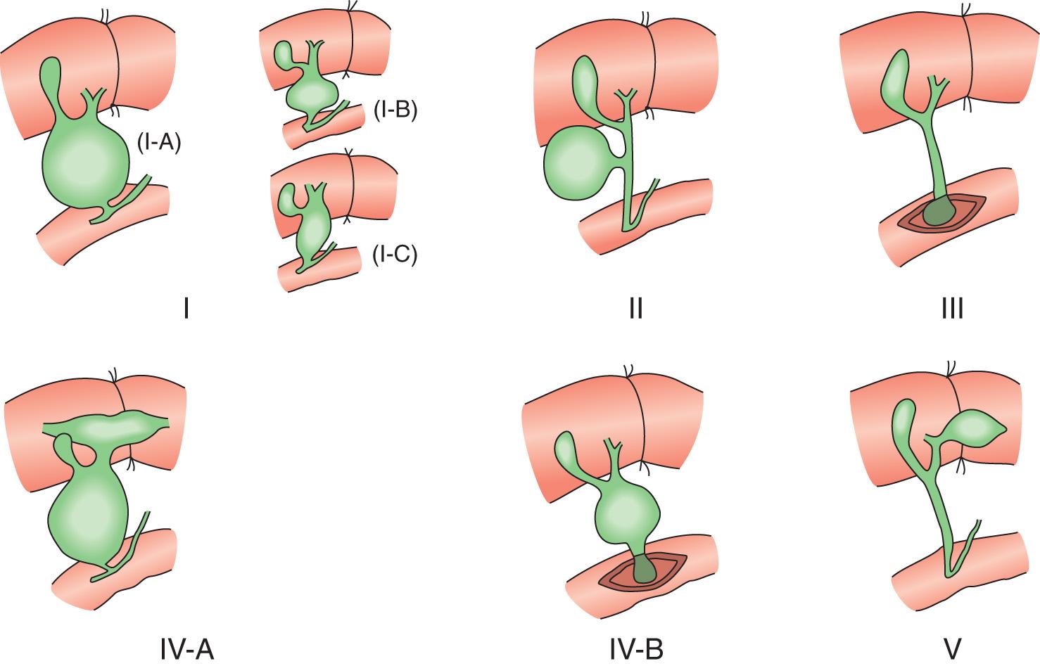 FIGURE 116.1, Classification of cystic disorders of the bile ducts.