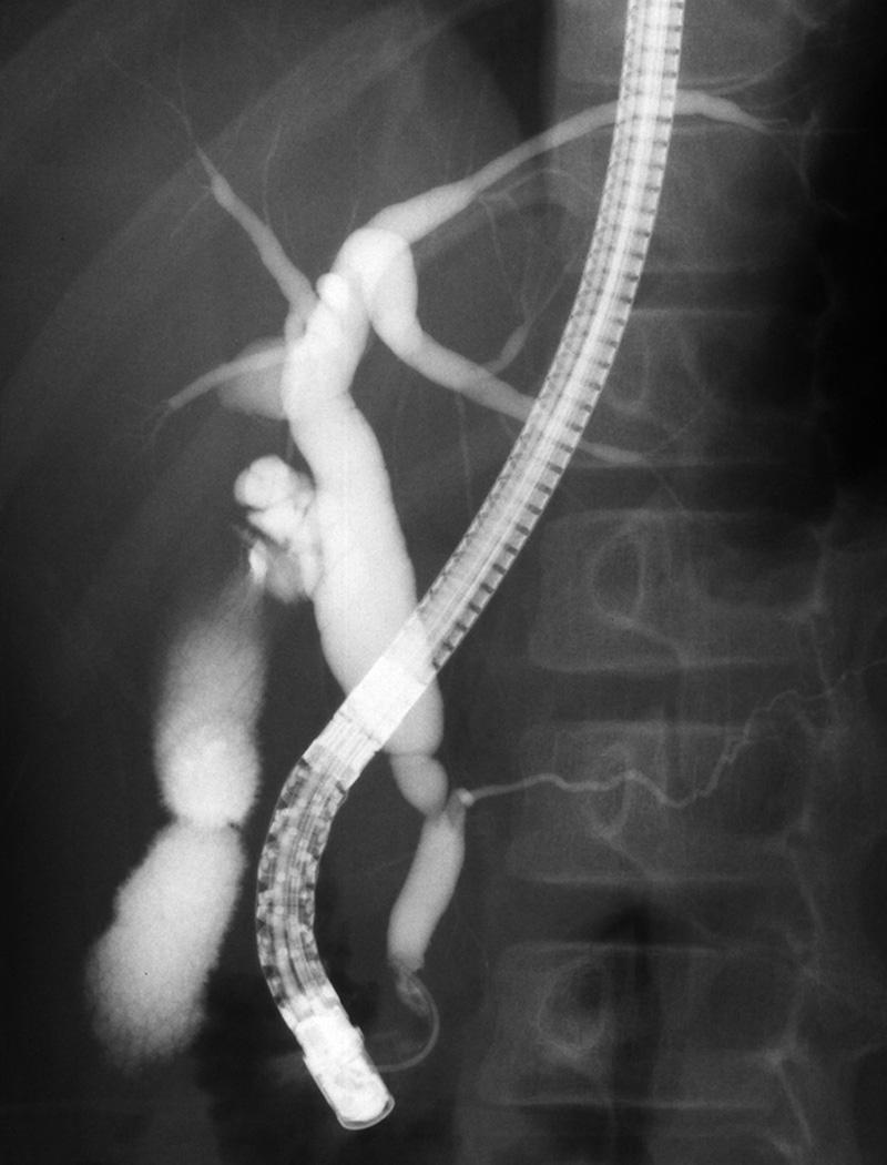 FIGURE 116.2, Endoscopic retrograde cholangiopancreatography shows congenital biliary dilatation without cystic dilatation of the extrahepatic bile duct.