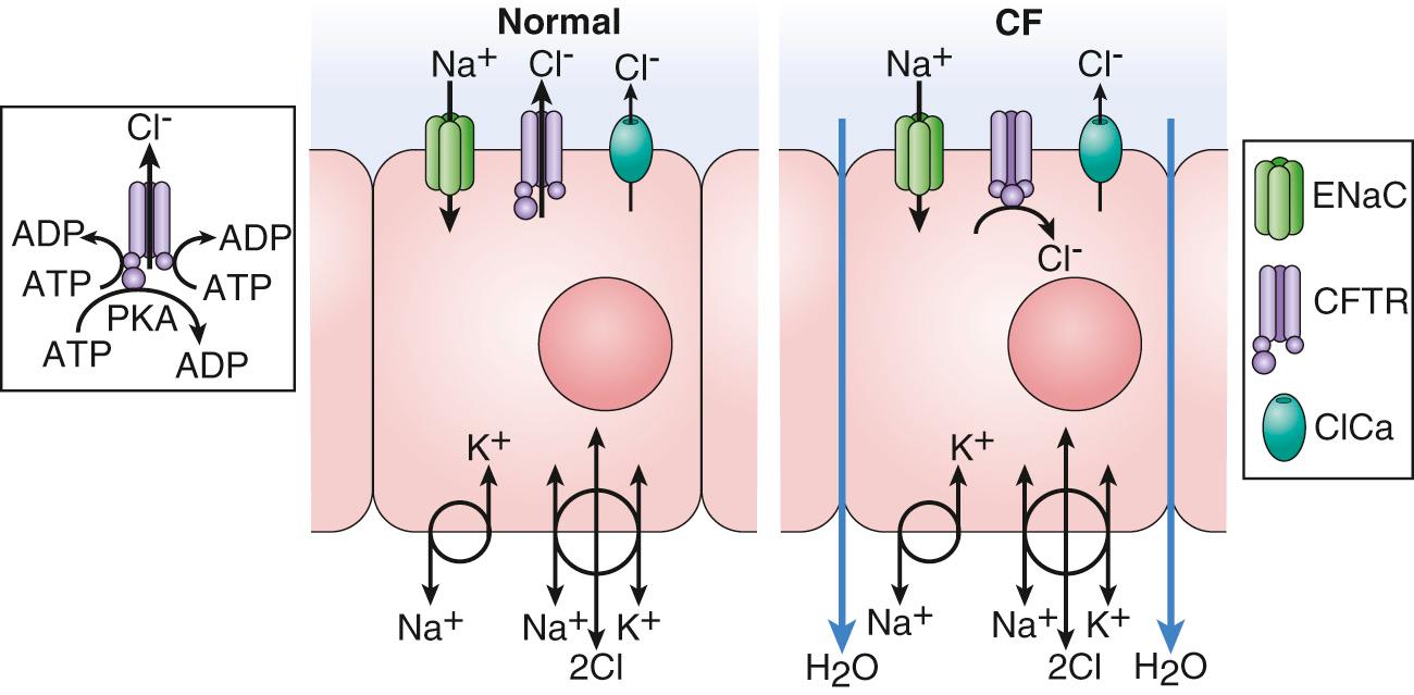 Fig. 432.3, Schematic diagram depicting cystic fibrosis (CF) epithelial channel defects, characterized by impaired chloride secretion, massive sodium absorption, and movement of water through the epithelium, leading to a dehydrated airway surface. ADP, Adenosine diphosphate; ATP, adenosine triphosphate; CFTR, cystic fibrosis transmembrane conductance regulator; ClCa, alternative chloride channel; ENaC, epithelium sodium channel; PKA, protein kinase A.