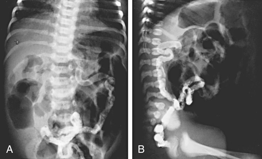 Fig. 432.6, A and B, Contrast enema study in a newborn infant with abdominal distention and failure to pass meconium. Notice the small diameter of the sigmoid and ascending colon and dilated, air-filled loops of small intestine. Several air-fluid levels in the small bowel are visible on the upright lateral view.