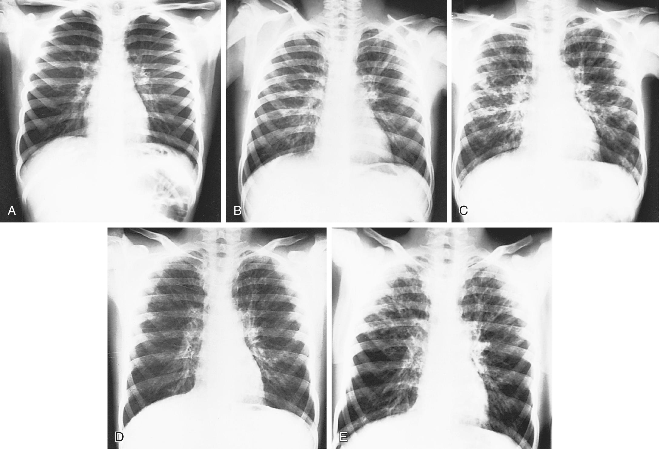 Fig. 432.7, Serial radiographs in a boy show the changing appearance of cystic fibrosis over 6 yr. A, At 9 yr, frontal radiograph shows minimal peribronchial thickening and hyperaerated lungs indistinguishable from asthma. B, Nineteen mo later, the radiographic picture has worsened considerably. Extensive peribronchial thickening is now noted. Mucoid impaction of the bronchus is seen in the left upper lobe and hilar shadows have become abnormally prominent. C, Ten mo later, further deterioration is obvious. Widespread typical changes of cystic fibrosis (CF) are noted throughout both lungs. D, Follow-up studies show considerable improvement, which suggested that some of the changes evident on C were from superimposed infection. E, One yr later, note the progressive changes of CF—most severe in the upper lobes bilaterally.