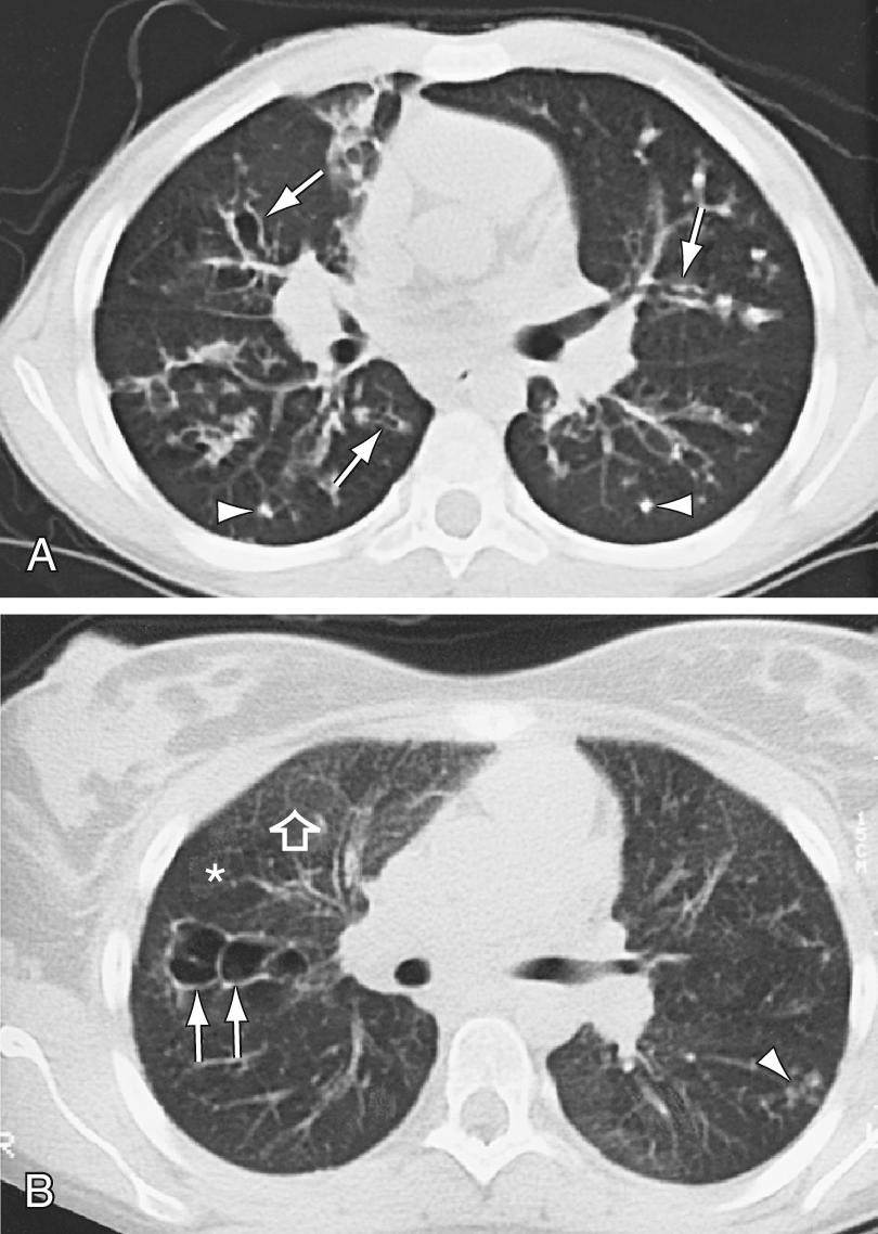 Fig. 432.8, CT scans of the chest in cystic fibrosis. A, A 12 yr old boy with moderate lung disease. Airway and parenchymal changes are present throughout both lungs. Multiple areas of bronchiectasis (arrows) and mucous plugging (arrowheads) can be seen. B, A 19 yr old girl has mostly normal lung with 1 area of saccular bronchiectasis in the right upper lobe (arrows) and a focal area of peripheral mucous plugging in the right lower lobe (arrowhead). Lung density is heterogeneous with areas of normal lung (open arrow) and areas of low attenuation reflecting segmental and subsegmental air trapping (asterisk).