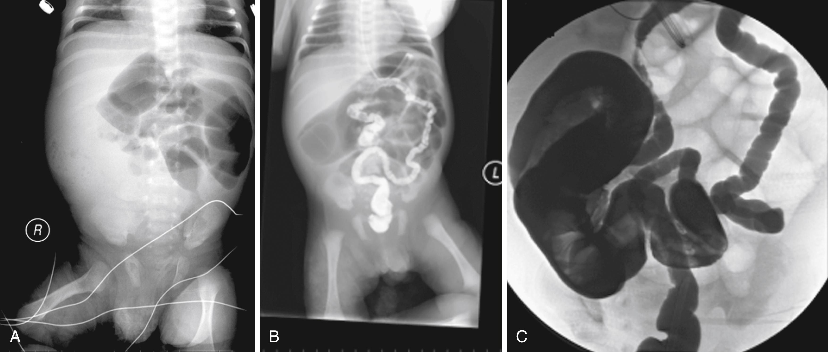 Fig. 81.3, (A) Abdominal radiograph of meconium ileus with a “bubbly” fullness in the right lower quadrant and dilated proximal small bowel loops. (B) Contrast enema in meconium ileus with dilated small bowel and unused microcolon. (C) Contrast enema in meconium ileus showing a huge dilated distal ileum with filling defects due to inspissated meconium. Dilated loops of small bowel and unused microcolon can also be seen.