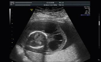 Fig. 70.1, Axial view of septated CH in second trimester. The nuchal ligament is identified.