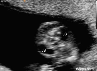 Fig. 70.2, Dilated jugular sacs (JS) in a case of resolved CH.