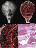 FIGURE 15-11, Aneurysmal bone cyst: radiographic and gross features.