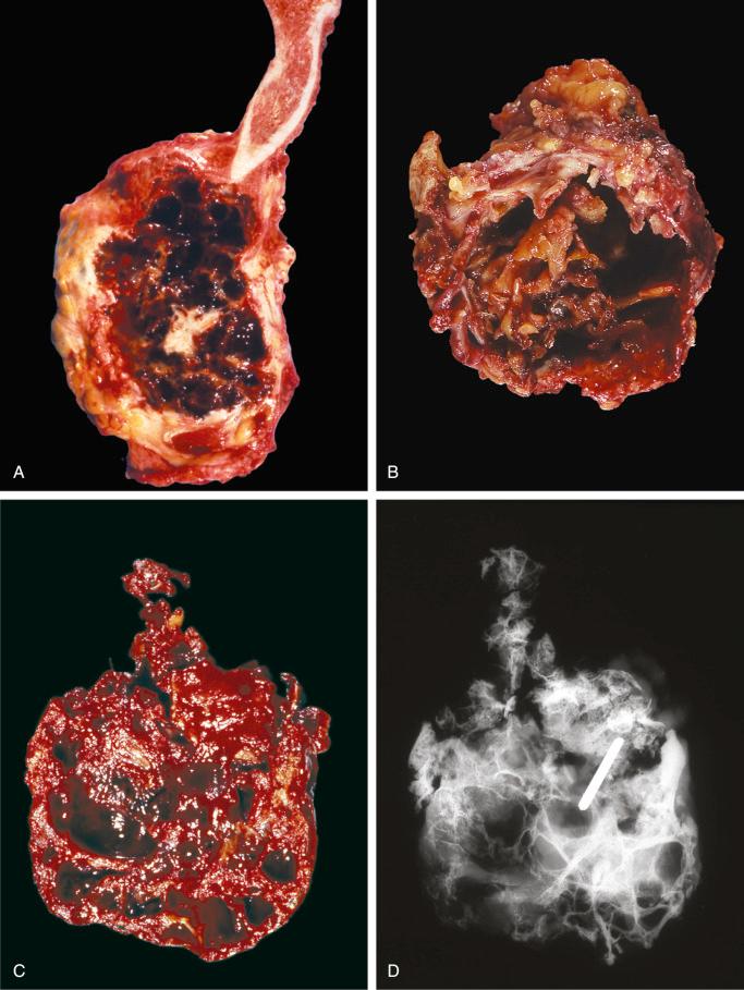 FIGURE 15-12, Aneurysmal bone cyst: gross features.