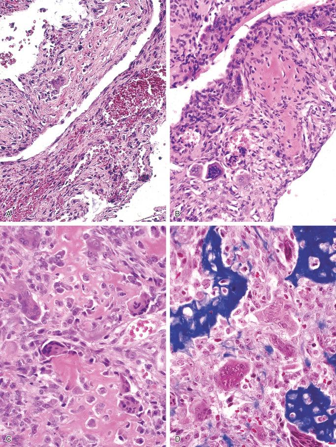 FIGURE 15-14, Aneurysmal bone cyst: microscopic features.