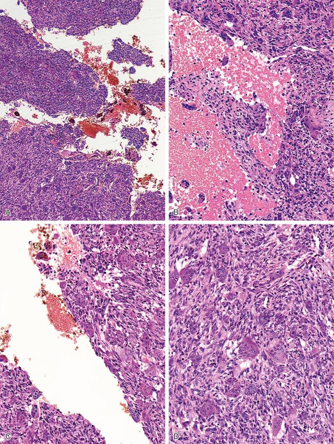 FIGURE 15-16, Aneurysmal bone cyst: microscopic features.