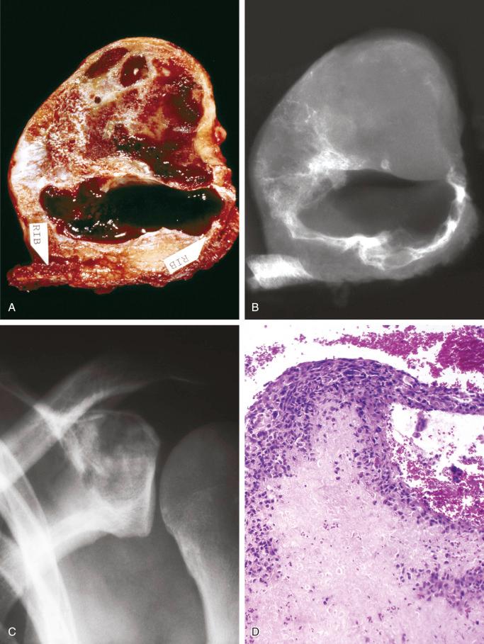 FIGURE 15-18, Secondary aneurysmal bone cyst: gross, radiographic, and microscopic features.