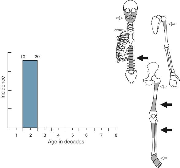 FIGURE 15-3, Aneurysmal bone cyst: peak age incidence and frequent sites of skeletal involvement.