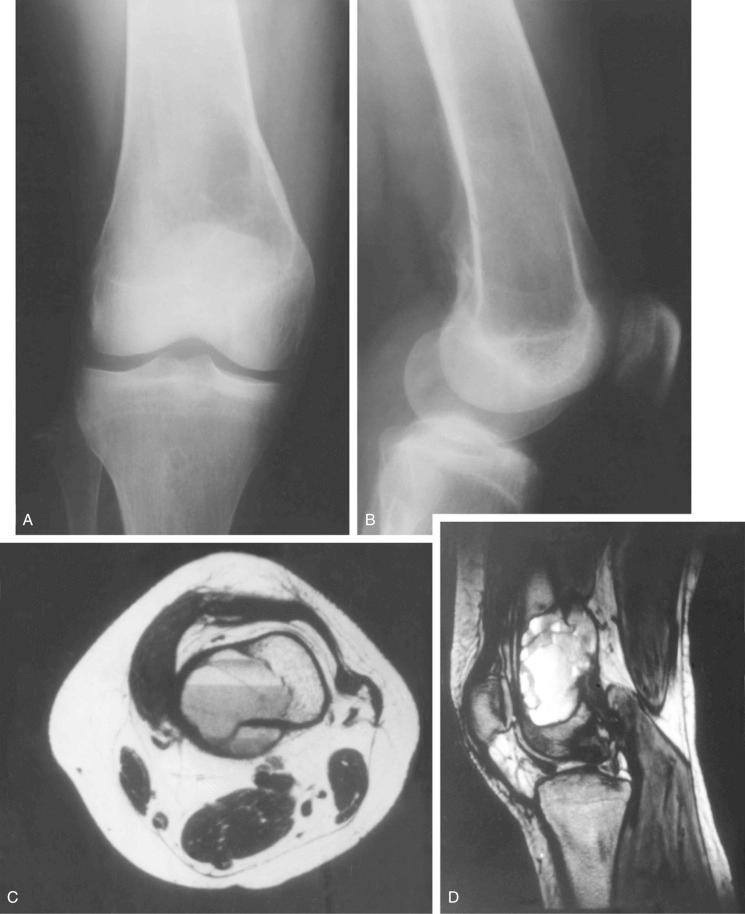 FIGURE 15-5, Aneurysmal bone cyst: radiographic features.