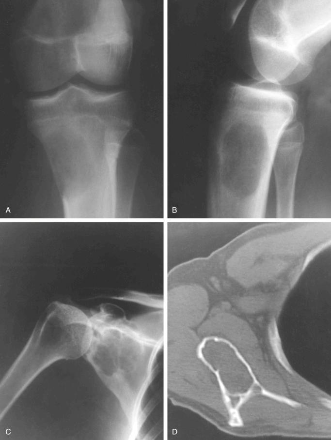 FIGURE 15-6, Aneurysmal bone cyst: radiographic features.