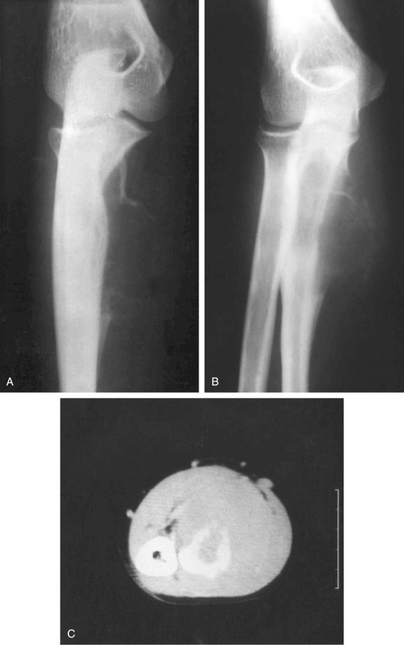 FIGURE 15-7, Aneurysmal bone cyst: radiographic features.