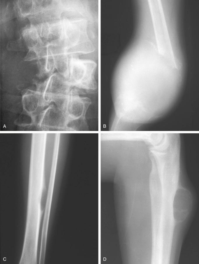 FIGURE 15-8, Aneurysmal bone cyst: radiographic features.