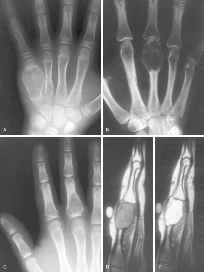 FIGURE 15-9, Aneurysmal bone cyst in short tubular bones: radiographic features.