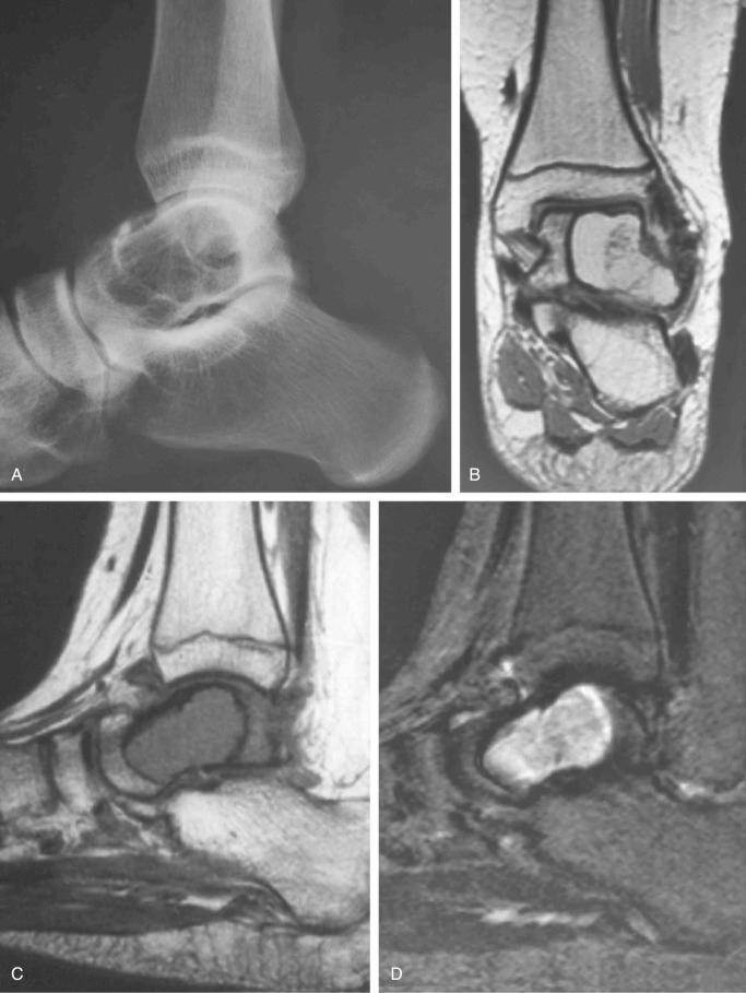 FIGURE 15-10, Aneurysmal bone cyst: radiographic features.