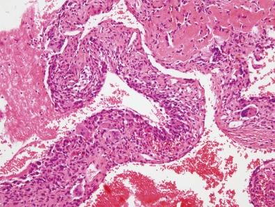 Figure 15-1, On low-power examination, this aneurysmal bone cyst shows multiple blood-filled cavities of varying sizes.