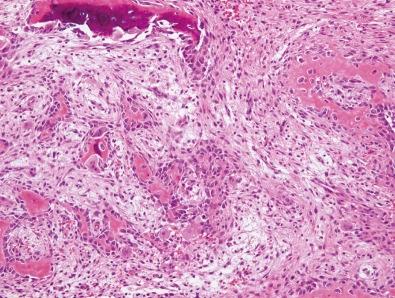 Figure 15-3, Reactive woven bone, rimmed by osteoblasts, is present in the fibrous septa.