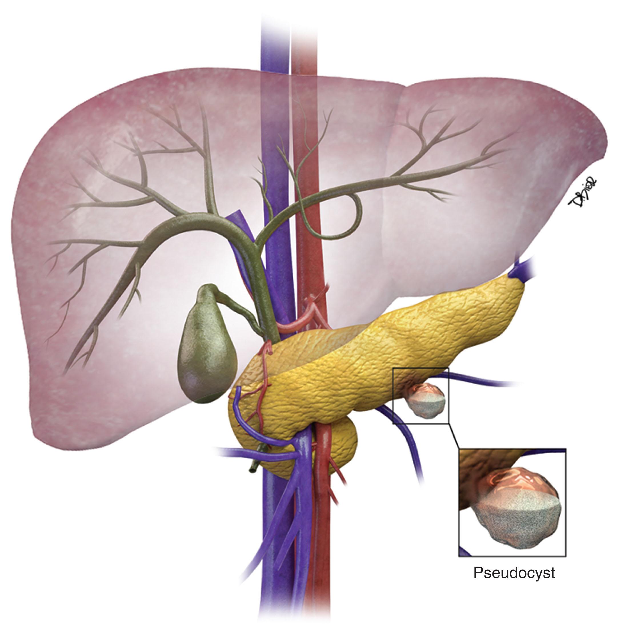 Figure 13.1, A cystic mass in the pancreatic tail contains debris representing a pseudocyst.