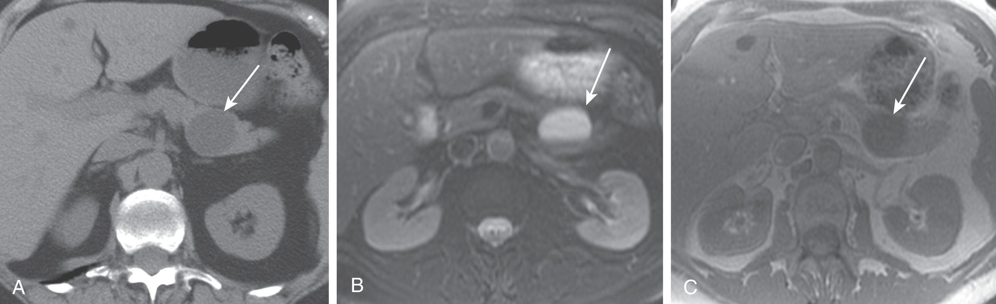 Figure 13.2, A 63-year-old woman with abdominal pain. A , Axial noncontrast computed tomography scan shows a cystic lesion in the pancreatic tail ( arrow ) without any internal septations. B , Axial T2-weighted magnetic resonance imaging (MRI) shows a high-signal intensity cystic lesion ( arrow ) in the pancreatic tail, containing debris. C , Axial T1-weighted MRI shows a low-signal intensity cystic lesion ( arrow ) in the pancreatic tail indicating the presence of a pseudocyst.