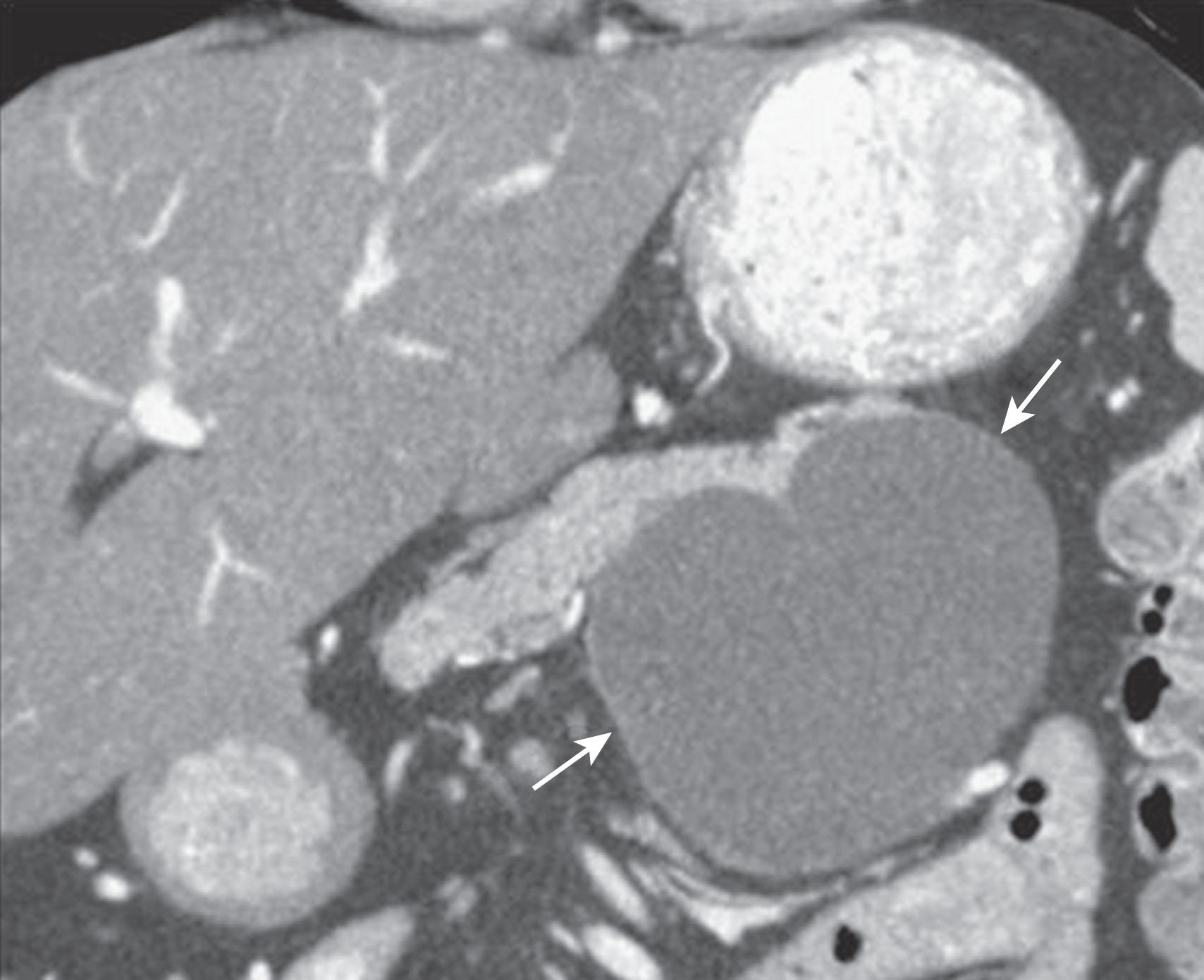 Figure 13.3, A 60-year-old woman in whom a cystic lesion was found incidentally on computed tomography (CT) colonography. Coronal reformatted CT scan of the abdomen shows a cyst ( arrows ) within the pancreatic tail, without internal septations or mural nodules, and represents a mucinous nonneoplastic cyst.