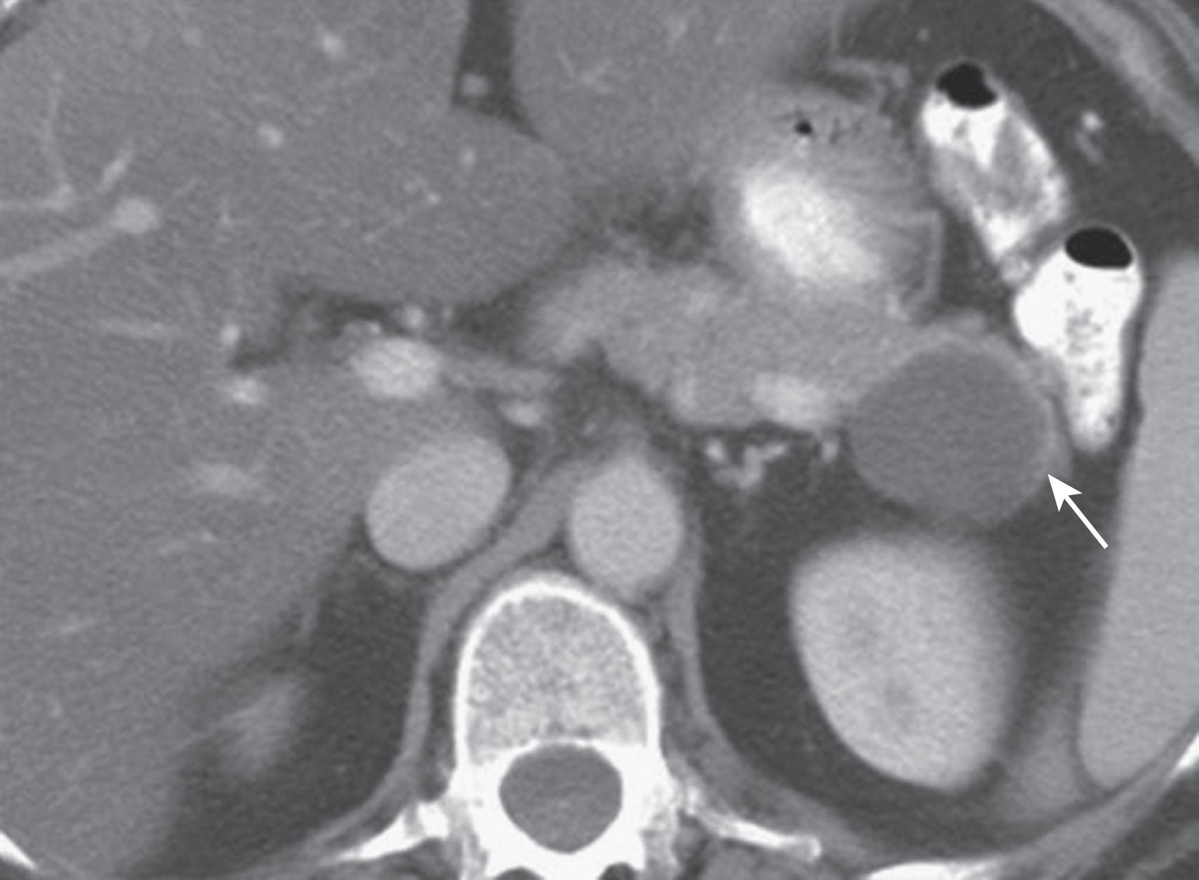 Figure 13.5, A 45-year-old woman with a history of right breast cancer presented with abdominal pain. Axial contrast-enhanced computed tomography shows a unilocular cystic lesion ( arrow ) in the pancreatic tail. The imaging findings are nonspecific, and the differential here would be pseudocyst and mucinous cystic neoplasm. However, the lack of a history of pancreatitis strongly suggests that this is a mucinous cystic neoplasm.