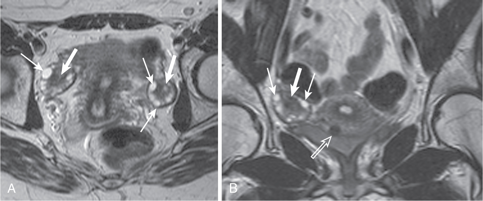 Fig. 33.1, Normal ovaries. Normal ovaries averaging 10 mL in size with subcentimeter ovoid, peripheral, subcentimeter follicle cysts ( thin arrows ) and central stroma ( thick arrows ) are easily identified. This is exemplified in the axial (A) and coronal (B) T2-weighted images. A small, partially subserosal fibroid protrudes from the anterior uterine body ( open arrow in B).