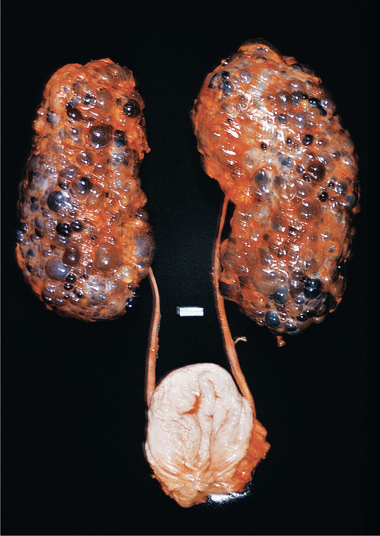 FIG. 9.1, Autosomal dominant polycystic kidney disease. The kidneys are markedly enlarged and consist of numerous cystic structures bulging through the surface. Many of the cysts contain dark material.