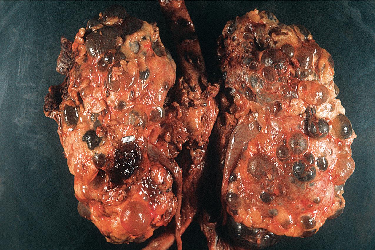 FIG. 9.2, Autosomal dominant polycystic kidney disease.