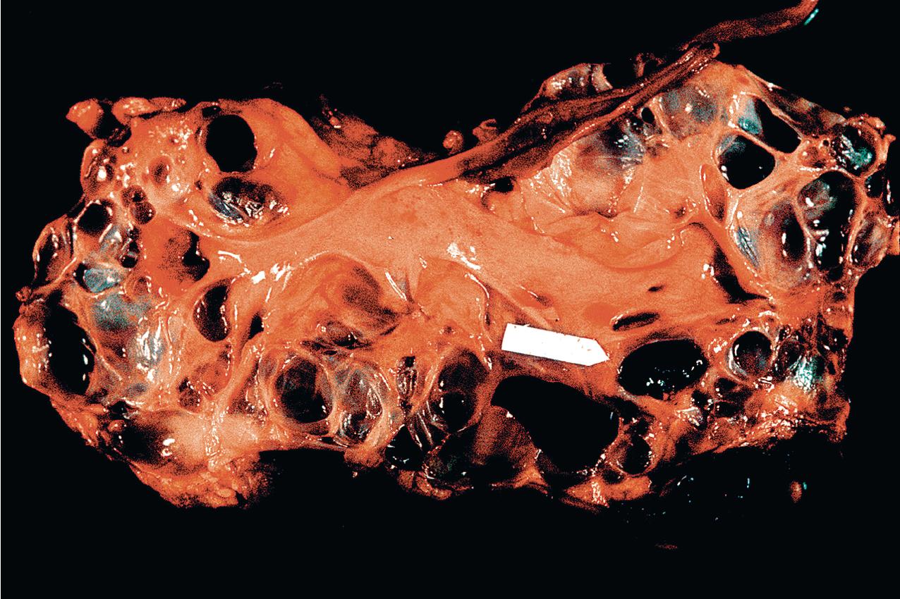 FIG. 9.3, Autosomal dominant polycystic kidney disease. Hemisection of the kidney shows cysts of varying size. (Reference measurement is 1 cm.)