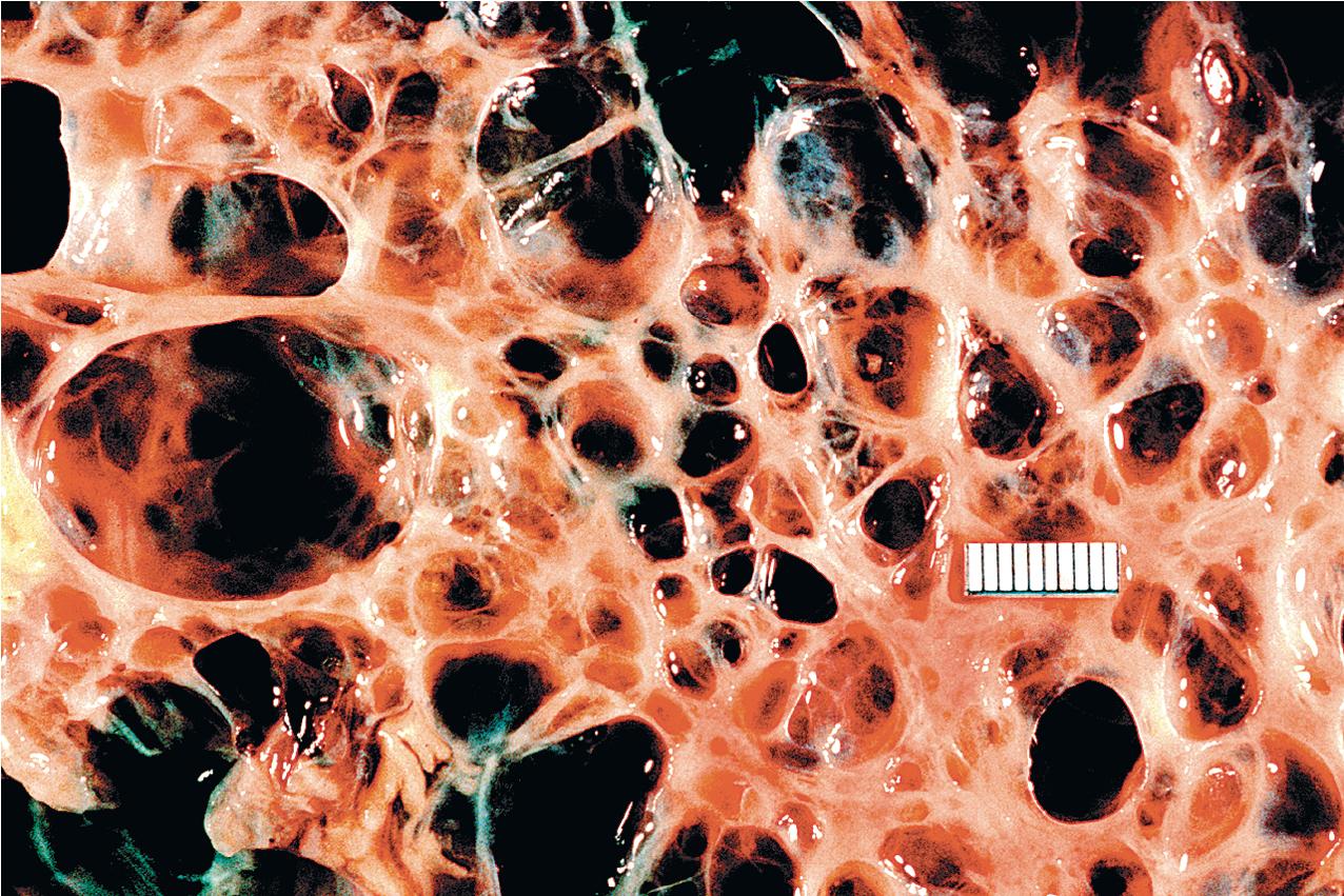 FIG. 9.4, Autosomal dominant polycystic kidney disease. Cut surface shows that the cysts are interspersed with fibrous tissue. (Reference measurement is 1 cm.)