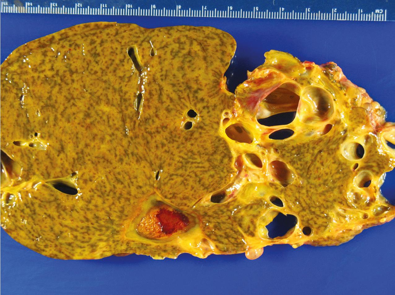 FIG. 9.5, Section of the liver from a patient with autosomal dominant polycystic kidney disease. One lobe of the liver demonstrates numerous noncommunicating cysts.