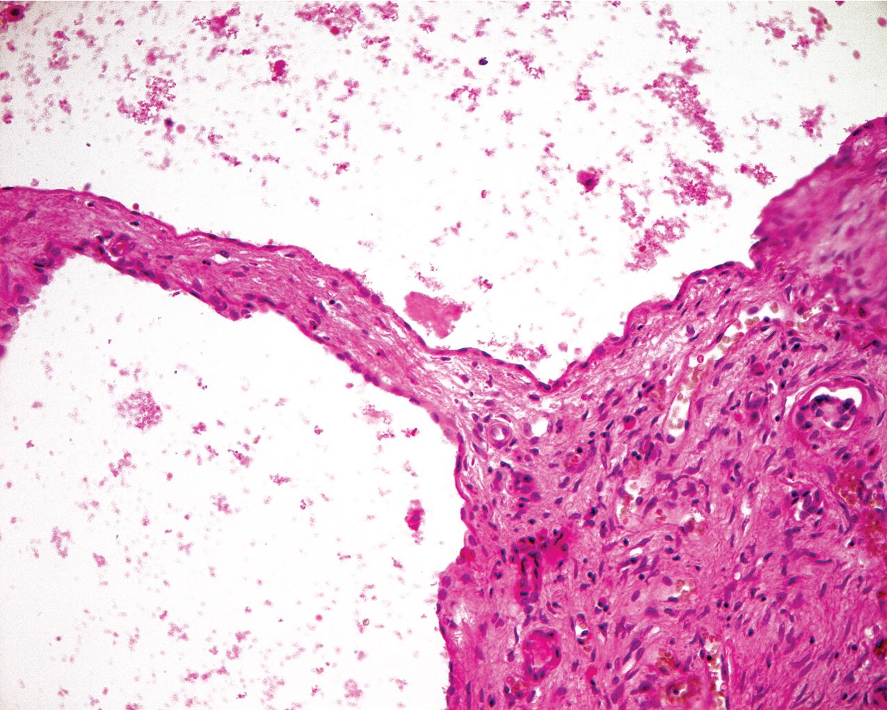 FIG. 9.6, Autosomal dominant polycystic kidney disease. Microscopic examination reveals the cysts to be lined by flattened epithelium and the interstitial tissue to consist predominately of fibrous tissue with small capillaries and atrophic tubules (hematoxylin and eosin, ×400).