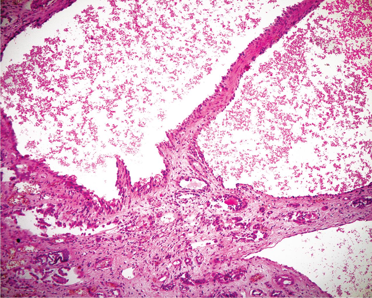 FIG. 9.7, Autosomal dominant polycystic kidney disease. In some areas, the cysts can be seen to displace normal tubular structures (hematoxylin and eosin, ×200).