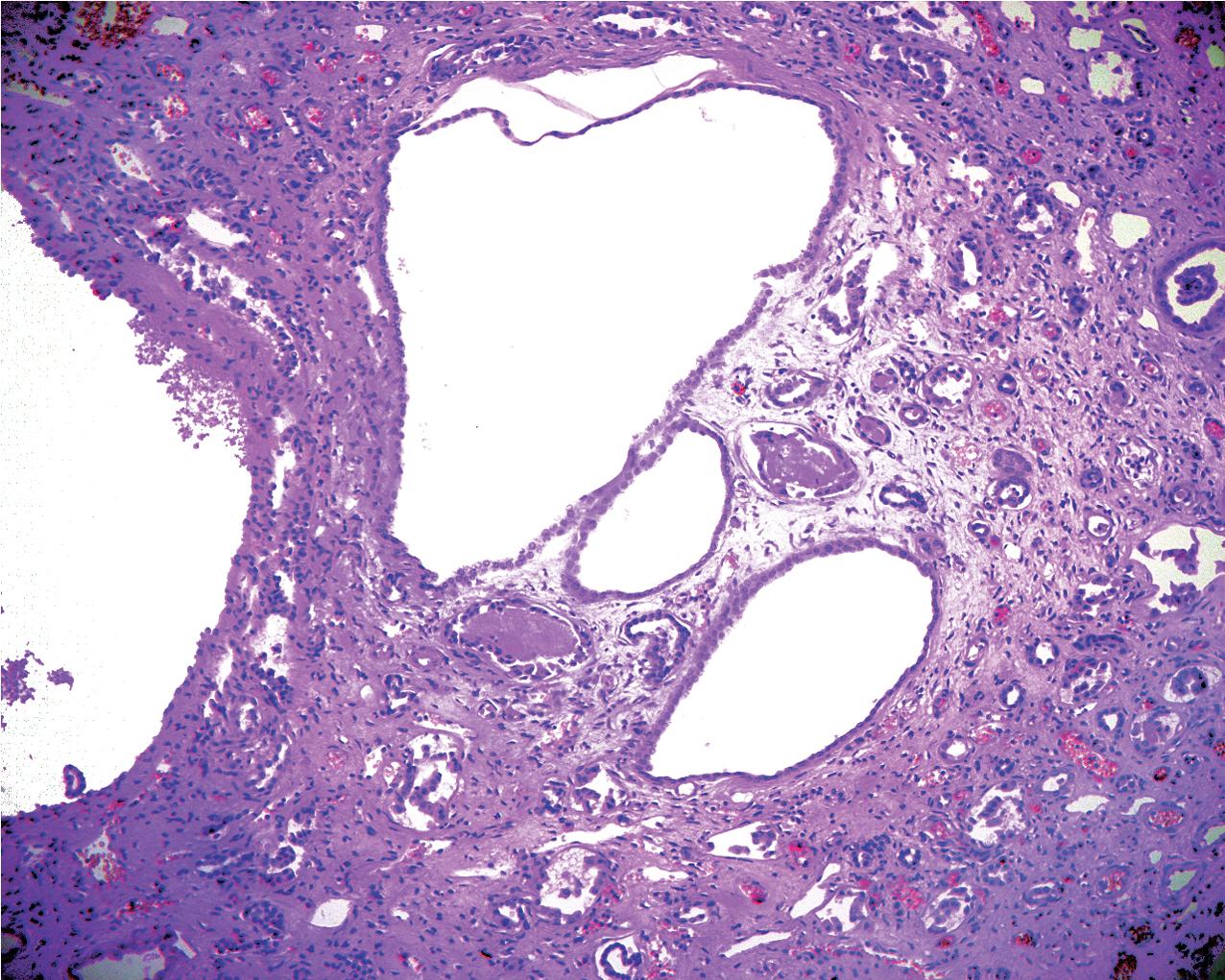 FIG. 9.8, Autosomal dominant polycystic kidney disease. Only a minority of the nephrons develop cysts. Normal tubular structures are scattered throughout the interstitial fibrous tissue (hematoxylin and eosin, ×200).