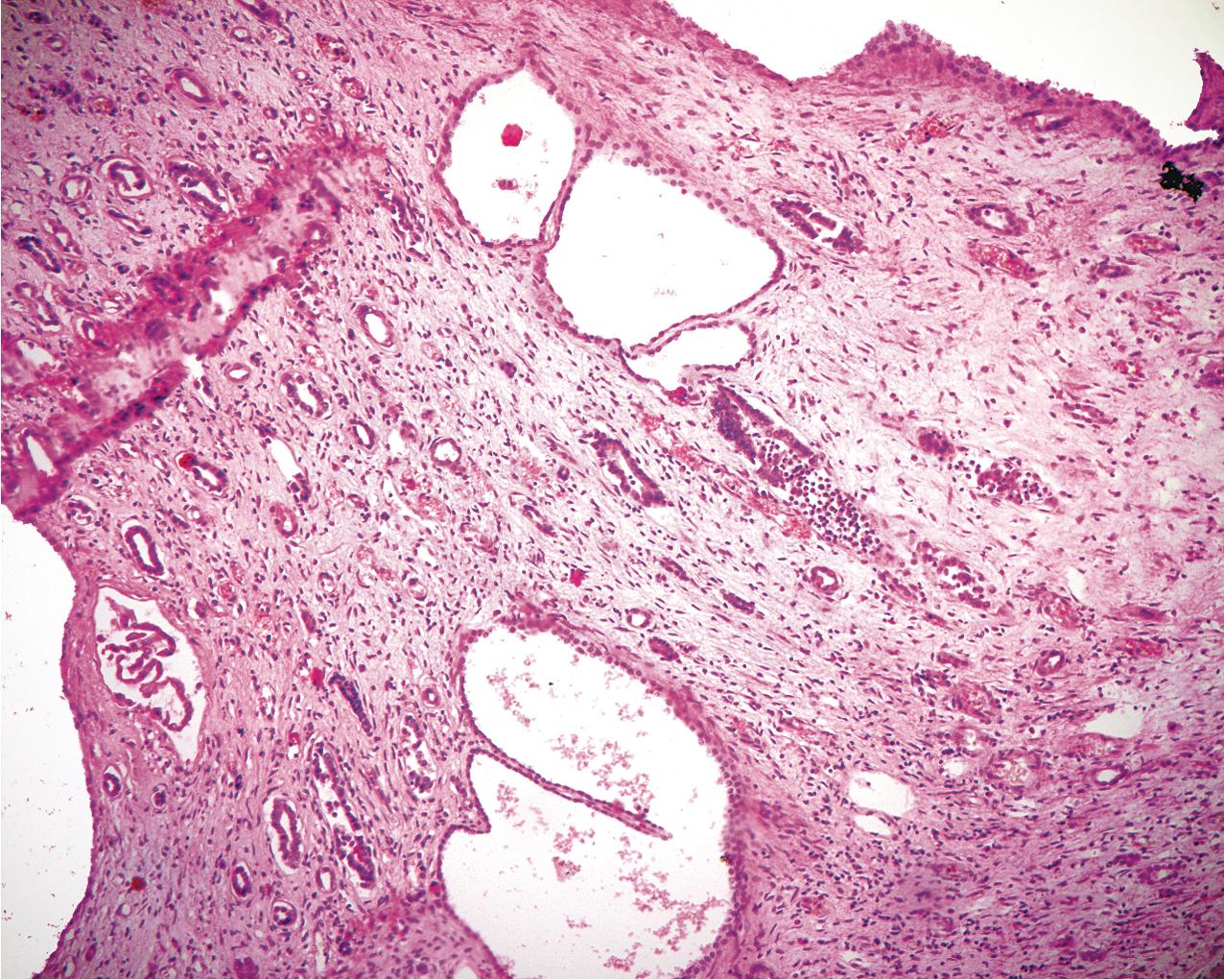 FIG. 9.9, Autosomal dominant polycystic kidney disease. Cysts involve both cortex and medulla and are seen extending into the inner medullary region (hematoxylin and eosin, ×200).