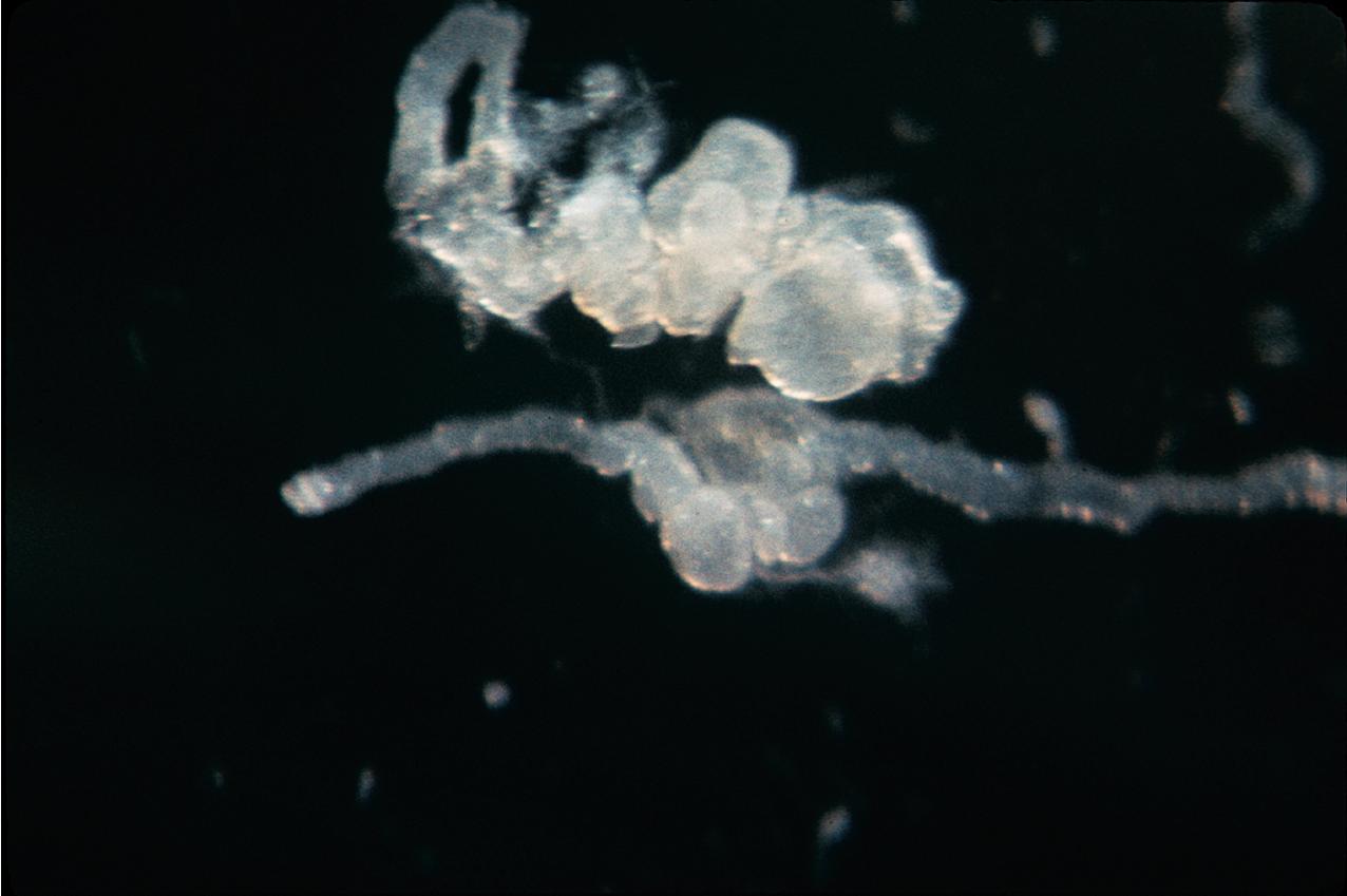 FIG. 9.10, Autosomal dominant polycystic kidney disease. The cysts initially begin as saccular aneurysmal dilations of the tubule that then separate from the tubule itself, as shown here in a microdissected specimen.