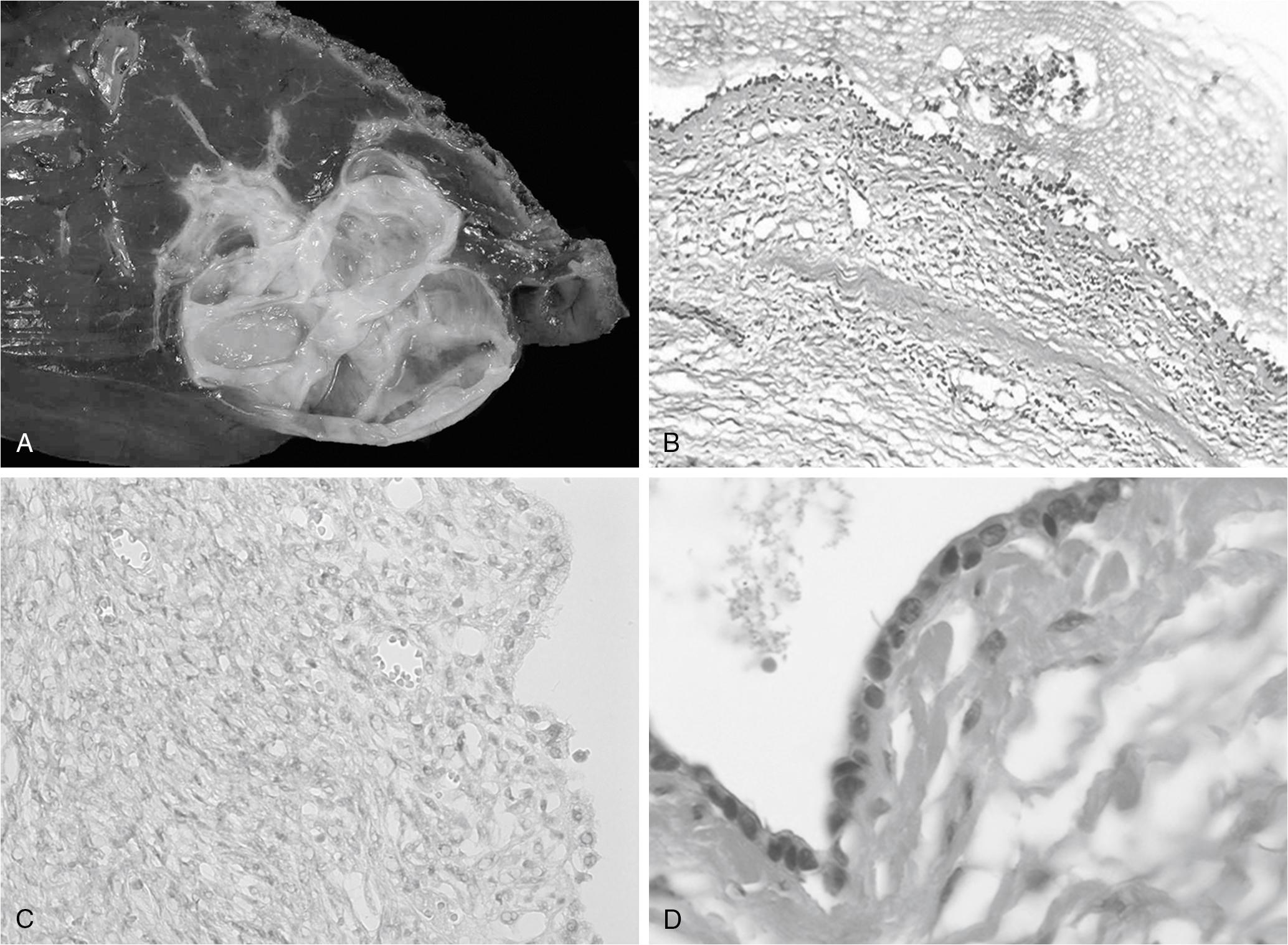 FIGURE 88B.3, Cystadenoma with ovarian-like stroma.