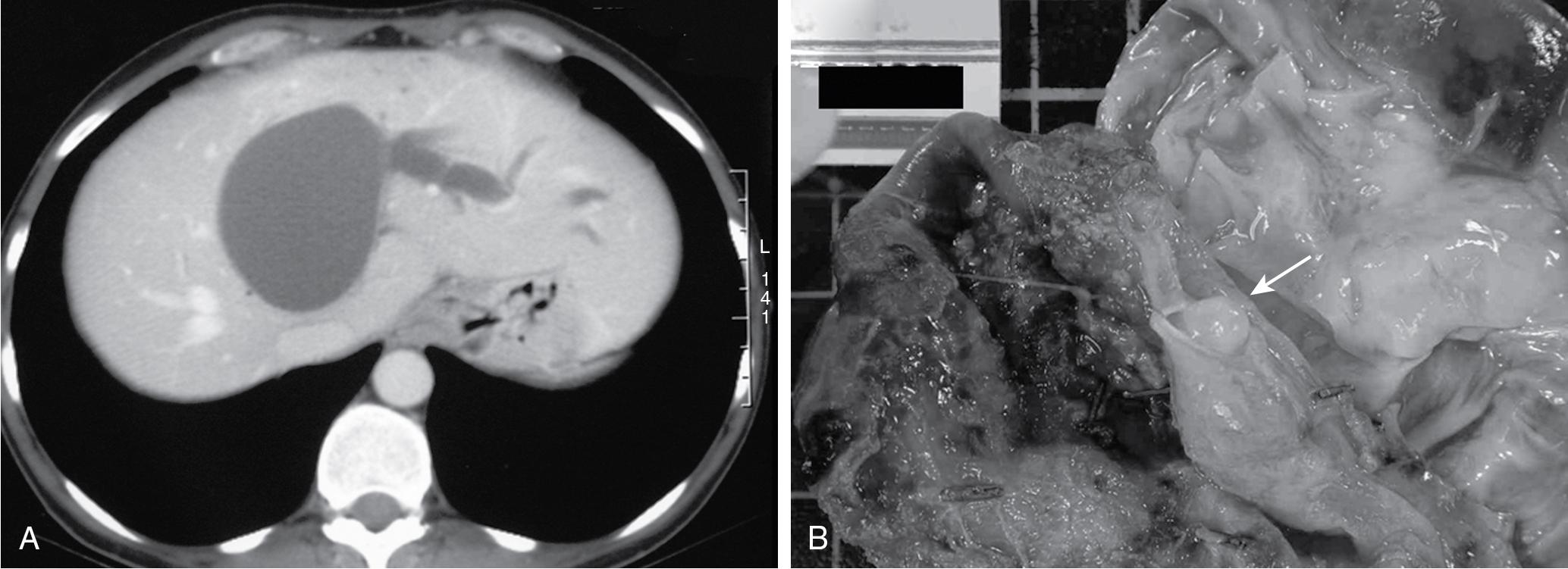 FIGURE 88B.4, Cystadenoma with ovarian-like stroma with tumor protrusion in the bile duct.